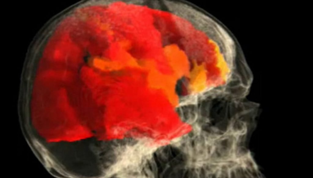 imagen de resonancia magnetica del cerebro de una mujer durante un orgasmo
